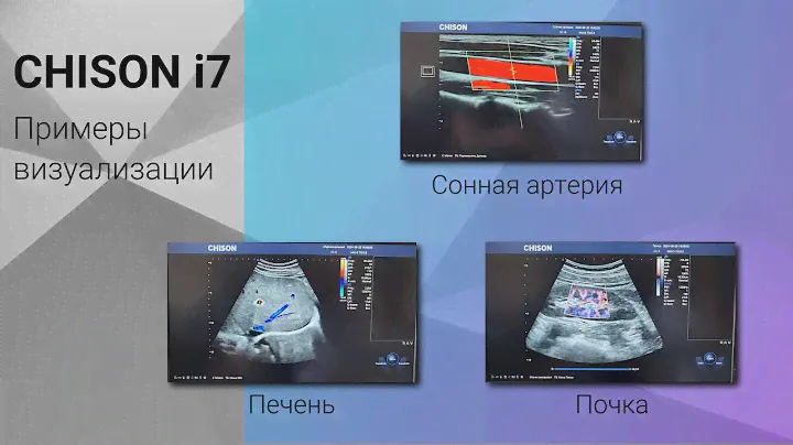 Chison i7 примеры визуализации